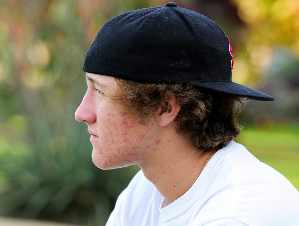 Sad teen boy outdoors with acne looking away from camera with black backwards hat and white shirt.